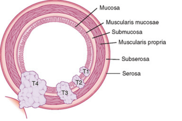 Anal cancer staging